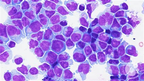 Cns Peripheral T Cell Lymphoma