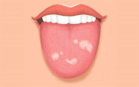 Make note of your symptoms to alleviate this what do white spots on tongue look like? This is What Your Tongue Can Say About Your Health ...