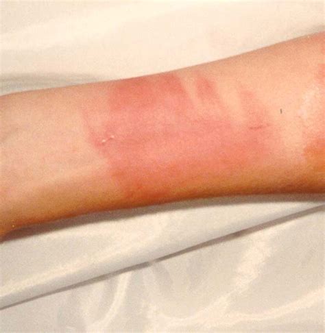 Here you may to know how to tell what degree a burn is. Natural medicine to cure first degree burn | Natural Pain ...