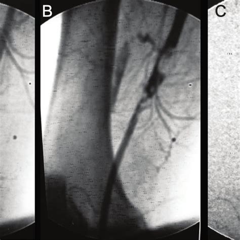 Angiografia digital do caso 4 A trombose da artéria femoral