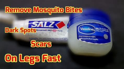 Only 2 Days How To Remove Mosquito Bites Scar Dark Spots