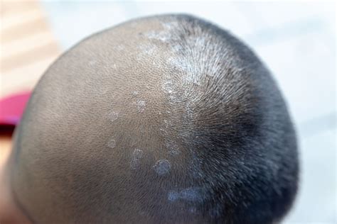 Pityriasis Versicolor Kopfhaut Shampoos Fur Schuppige Und Juckende
