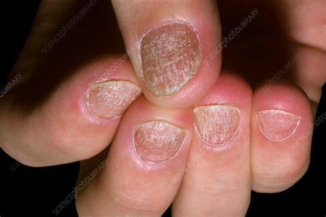 Psoriasis Of The Fingernails Stock Image C0372758 Science Photo