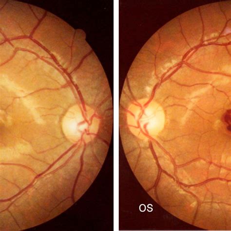 A Fundus Photo Ou Obtained At The Initial Examination This Photo Of