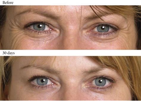 botox and dysport services offered by the eye care center