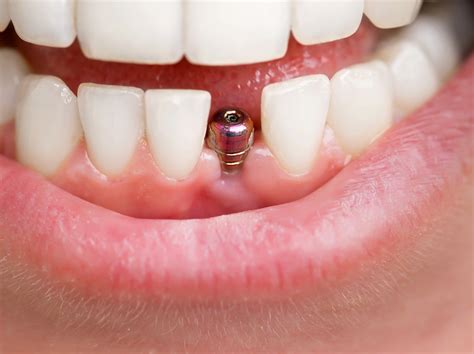 Tooth Implant Placement Before During After General And Cosmetic