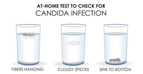 Candida Overgrowth Candidiasis Complete Guide On Treating Candida