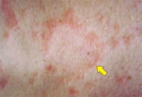 12 Rashes You Need To Know Common Dermatologic Diagnoses