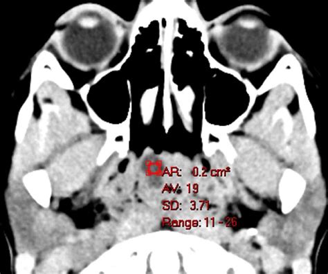Nasopharyngeal Retention Cyst Neuro Mr Case Studies Ctisus Ct Scanning