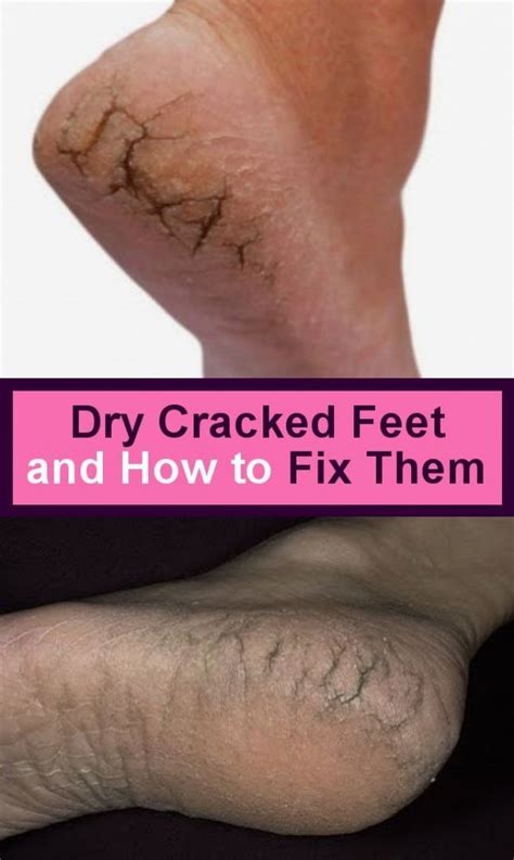 Dry Cracked And Fixing Feet In 2020 Dry Cracked Feet Cracked Feet