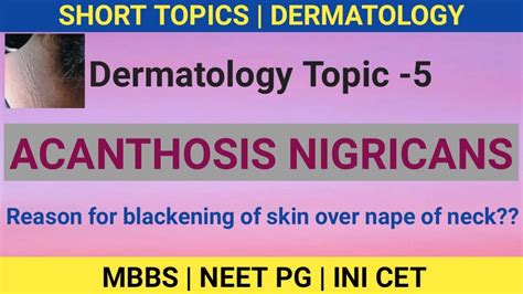 Acanthosis Nigricans Pcod Insulin Resistance Dermatology Topic 5