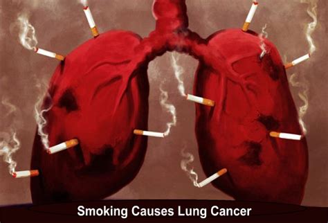 Lung Cancer Causes Symptoms And Signs Health And Medical Information