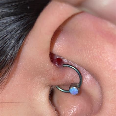 6 Month Old Daith Piercing Suddenly Has A Blood Bubble On It The