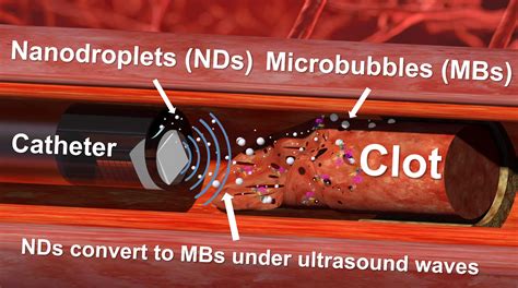 Ultrasound “drills” And Nanodroplets And Prove Effective At Tackling