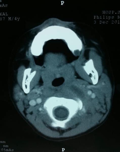 Cect Neck Of Axial View Showing The Site Of Abscess Collection White