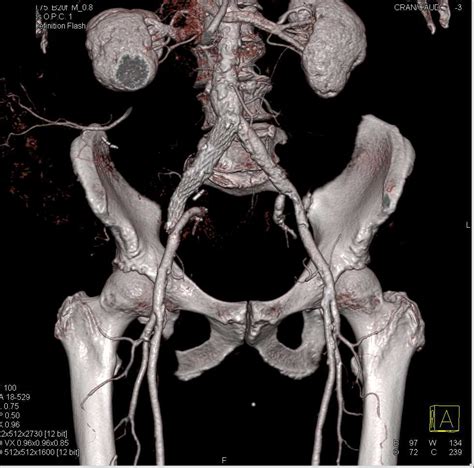 Cta With Stent In Right Common Iliac Artery Vascular Case Studies