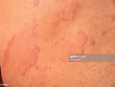 Hives Urticaria Skin Disease Photo Getty Images