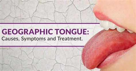 Geographic Tongue Disease