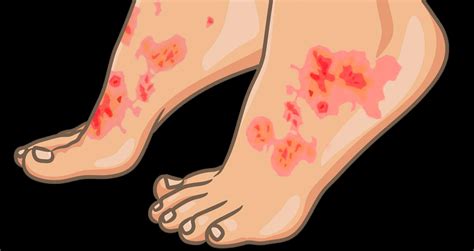 What Is Plaque Psoriasis Symptoms Causes And Treatments
