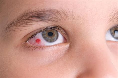 Common Symptoms Of Red Eye