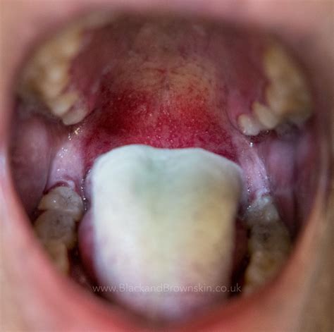 Scarlet Fever Tongue — Black And Brown Skin