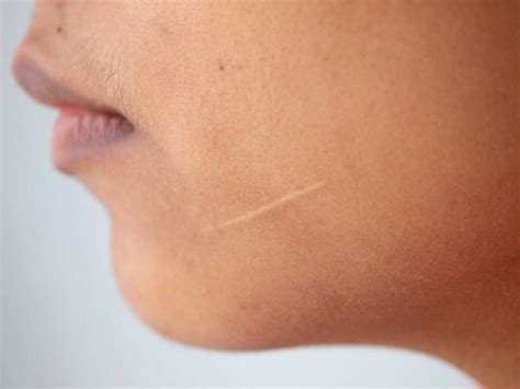 Keloids Hypertrophic Scars Dermatology Sydney