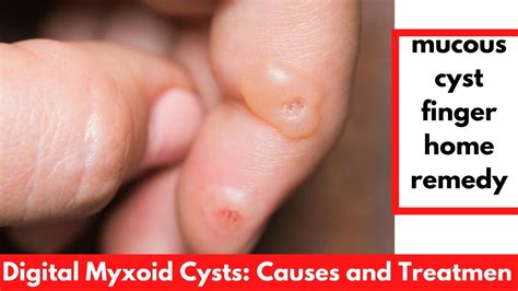 Mucous Cyst Finger Home Remedy Digital Myxoid Cysts Causes And