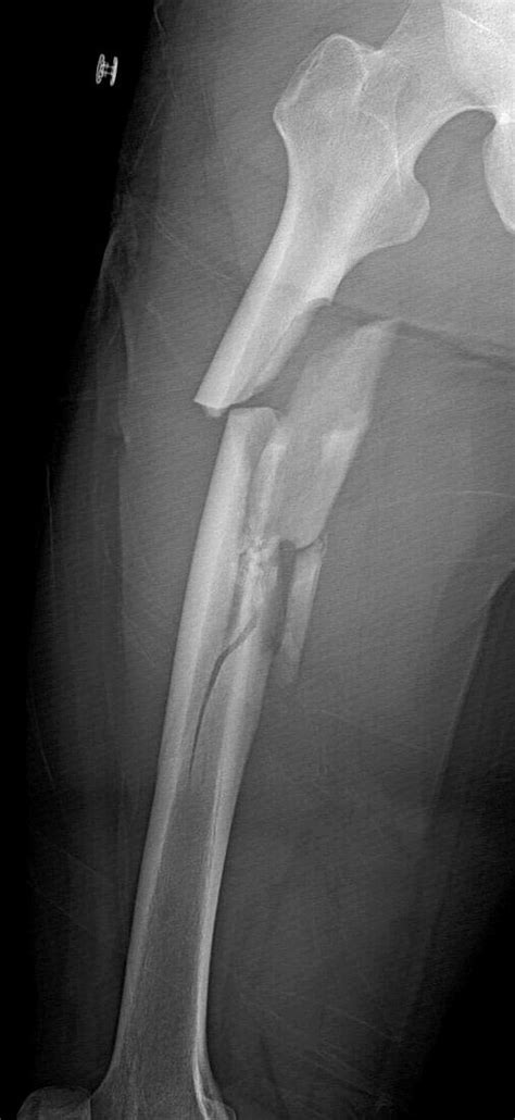 Comminuted Femur Fracture X Ray Bild Kaufen 13621792 Science Photo