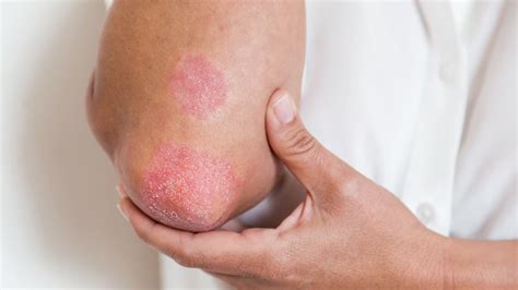 Common Skin Rashes Skin And Beauty Center Everyday Health