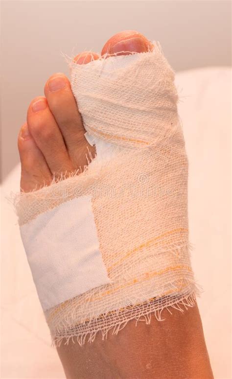 A Persons Bandaged Up Broken Big Toe Stock Image Image