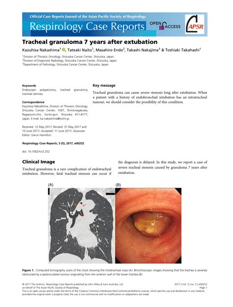 Pdf Tracheal Granuloma 7 Years After Extubation