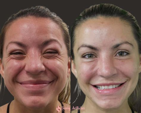 Botox Before and After Results - Everything You Need to See & Know