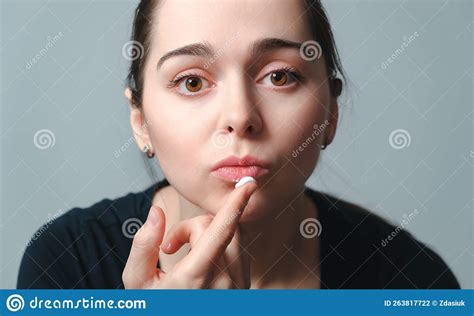 Virus Herpes On Lips Close Up Beautiful Woman Holds On Finger A Cream Drop In Front Of Painful