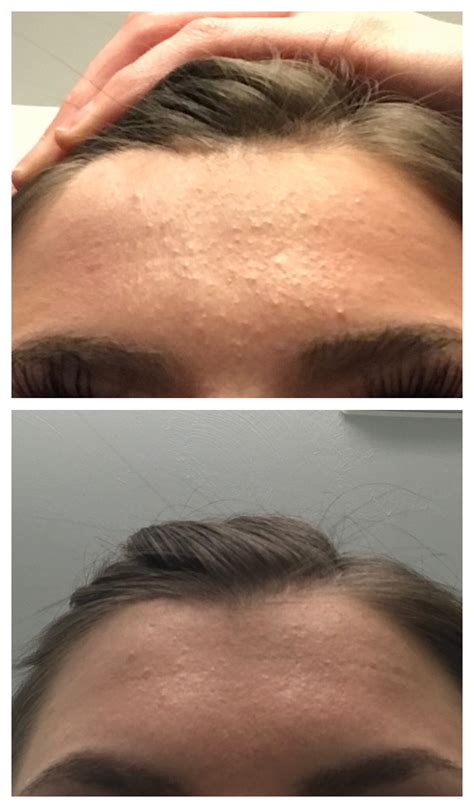 My Forehead Bump Acne Progress With Vitamin A Info In Comments Racne