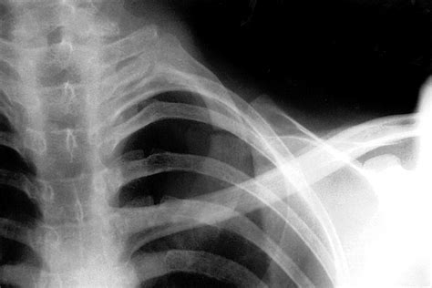 Isolated Fracture Of The First Rib Without Associated Injuries A Case