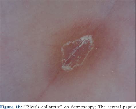 Figure 1 From Dermoscopy Of Bietts Sign And Differential Diagnosis