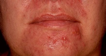 What are the possible complications of sebaceous hyperplasia? Sebaceous Hyperplasia - Pictures, Treatment, Causes, Symptoms