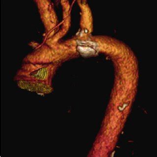 3D Reconstruction Of The Aortic Arch Shows The Location Of The Arch