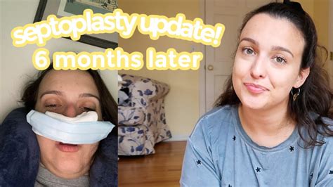 My Septoplasty Update 6 Months Later Was It Worth It My Full Recovery And Thoughts Youtube