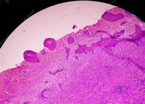 Premium Photo Skin Biopsy Under Microscopy Suggestive Of Basal Cell