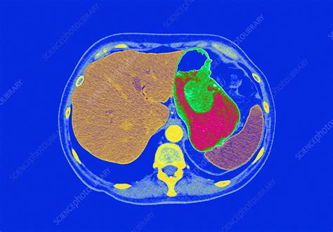 Stomach Cancer Ct Scan Stock Image C0261110 Science Photo Library