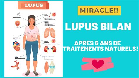 Lupus Bilan Apres 6 Ans De Traitement Naturel Miracle Youtube