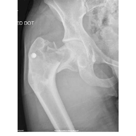 Antero Posterior And Lateral Radiographs Of The Right Hip Showing