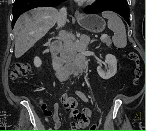 Lymphoma With Bulky Nodes In The Mediastinum And Abdomen Chest Case
