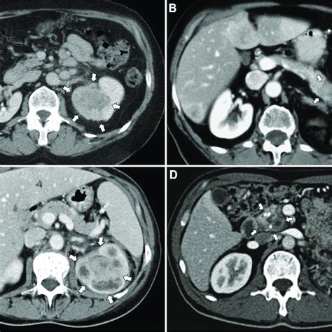 Computed Tomography Image Of A Primary Rcc Tumor In The Left Kidney A