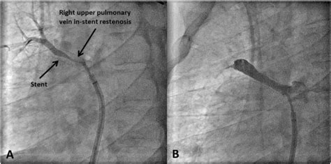 Right Upper Pulmonary Vein Stenosis Requiring Multiple Interventions
