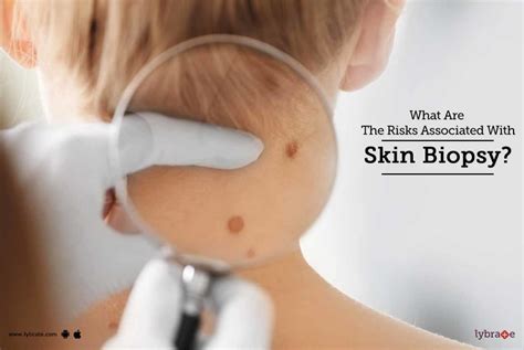 What Are The Risks Associated With Skin Biopsy By Dr Anvika Mittal