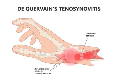 What Are The Causes Of De Quervains Tenosynovitis The Best Porn Website
