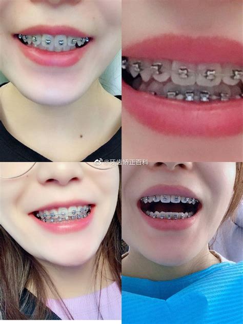 Pin By Shrood Burgos On Braces In 2021 Braces Tips Brace Face Smile