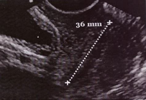 Figure From Significance Of Transvaginal Sonographic Assessment Of